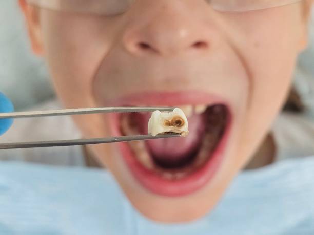 Best Emergency Treatment for Dental Infections or Abscesses in Newman, CA
