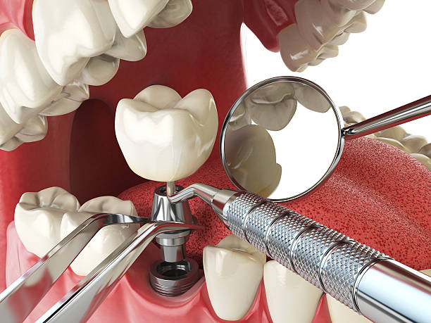 Best Emergency Wisdom Teeth Removal in Newman, CA